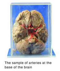 brain coronal  section