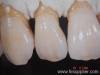 porcelain teeth, porcelain materials tooth