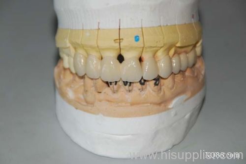 porcelain material tooth