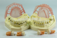 periodental disease model