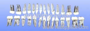 permanent teeth metal root resin crown