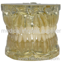 transparent tooth extraction model