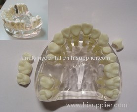 Dental Implant