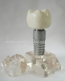 6 times Dental Implant model