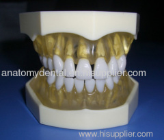 Transparent Gingivae 28 Removable Teeth