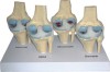 Pathological Model of Knee Joint