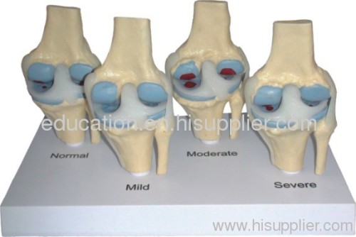 Pathological Model of Knee Joint