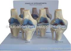 Pathological Model of Knee Joint with card