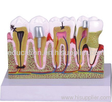 Tooth Common Disease
