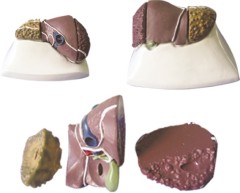 Model of Liver Cancer