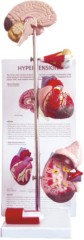 Model of Hypertension