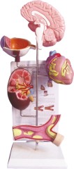 Model of Hypertension