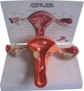 Pathological Uterine Model