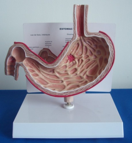 diseased stomach model,gastric ulcer model,