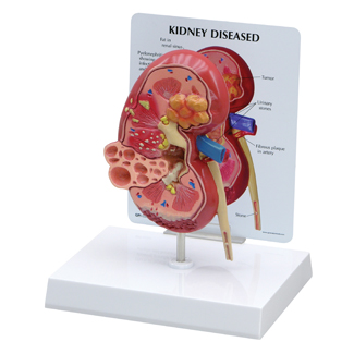 Human Kidney Model with Pathologies