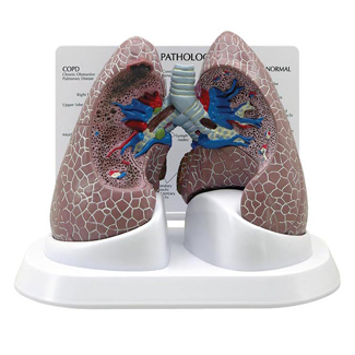 Human Lung Model with Pathologies ,cancer model,pharmaceutical promotion model