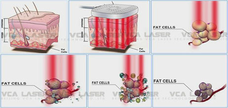 Professional Lipolaser Slimming System Home Use Machine