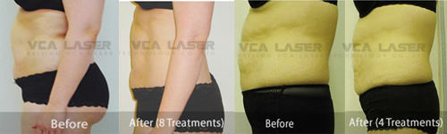 Elight(ipl+rf )+rf +nd Yag Laser+cavitation 4 In One Hair Removal Multifunctional Machine