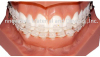 Orthodontic Ceramic Easthetic Bracket