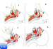 Medical consumable laryngeal mask