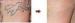 Professional Q-Switched Nd Yag Laser tattoo removal equipment short pulse width 6 ns