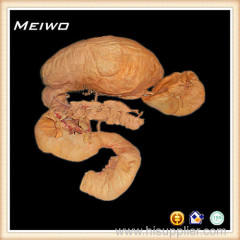 Pancreas and duodenum plastination