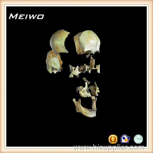 Separation of the skull bone human skull bone