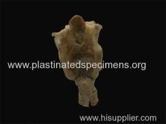 Laryngeal cartilage medical specimen collector