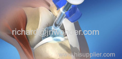 sodium hyaluronate gel injection for joint surgery