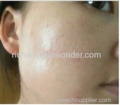 External use for anti-acne Recombinant Basic Fibroblast Growth Factor