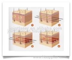 NOBLE Lift Cogged thread/Barbed PDO thread for face lifting