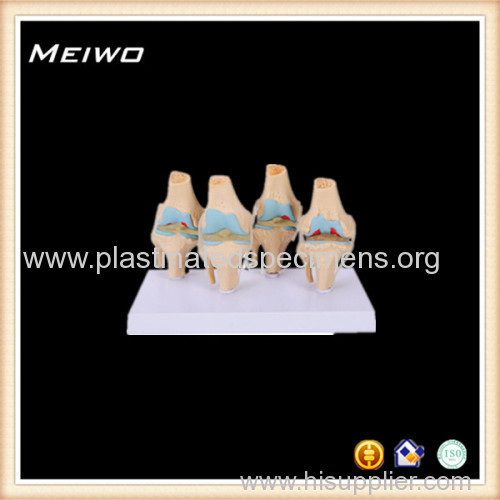 normal and pathologic knee joints set buy anatomy models