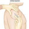 Capulohumeral Periarthritis Medical Sodium Hyaluronate Gel High Viscoelastic HA