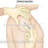 Capulohumeral Periarthritis Medical Sodium Hyaluronate Gel High Viscoelastic HA