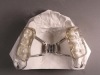 Bonded Rapid Palatal Expander Bonded Rapid Palatal Expander