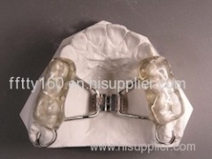 Bonded Rapid Palatal Expander Bonded Rapid Palatal Expander