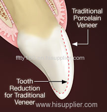 Fixed Restoration Lumineers Veneers