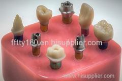 Fixed Restoration Customized Abutment