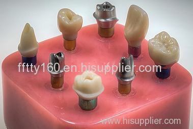 Fixed Restoration Customized Abutment