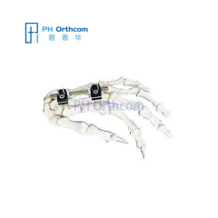 Lengthening Penning MinFixator Orthofix Mini Fragment External Fixation Device System Trauma Orthopedic