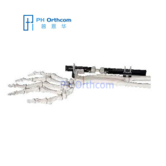 Динамические наручные внешний фиксатор для внесуставных переломах & Корректирующее остеотомий Orthofix Тип Fixator