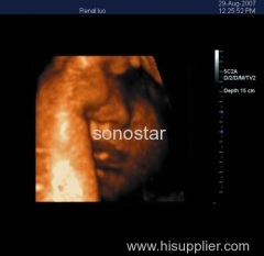 C5 Laptop Color Doppler Ultrasound (System Ultrasound Color Doppler Portable)