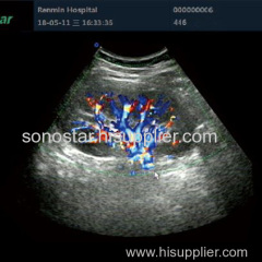 SS-2000 Sonostar cheap trolley doppler ultrasound machine color ultrasound scanner