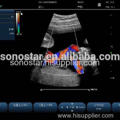 SS-1000 Sonostar Trolley professional color doppler ultrasound machine China ultrasound scanner