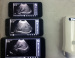 Sonostar Android & IOS system ultrasound scanner mini ultrasound machine UProbe-2