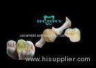 Full Casting ceramic Dental Inlays Beautiful and Durable no any allergy