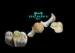Full Casting ceramic Dental Inlays Beautiful and Durable no any allergy