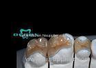 Large Cavities Porcelain Dental Inlays Endodontically treated teeth