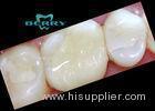 Composite Tooth Veneers Dental Inlays small damage of tooth surface