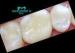 Composite Tooth Veneers Dental Inlays small damage of tooth surface